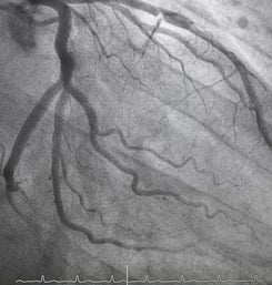 Peripheral Angiogram