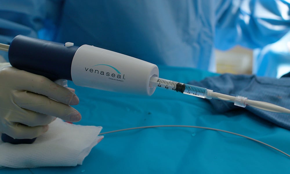 Non-Thermal Adhesive Vein Ablation Procedures